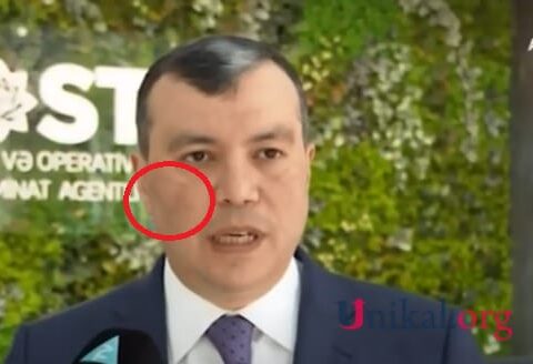 Sahil Babayevin xəstəliyinin adı bilindi – FOTO