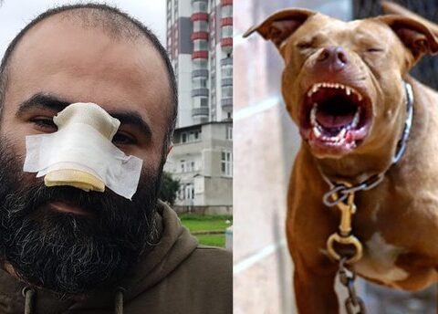 Türkiyədə azərbaycanlı biznesmenin burnunu pitbul QOPARDI – FOTOLAR