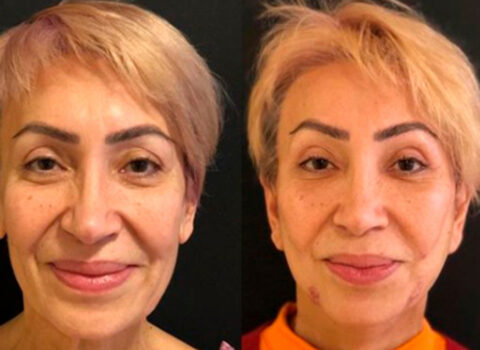 60 yaşlı Əməkdar artist cavanlaşmaq üçün ƏMƏLİYYAT ETDİRƏCƏK