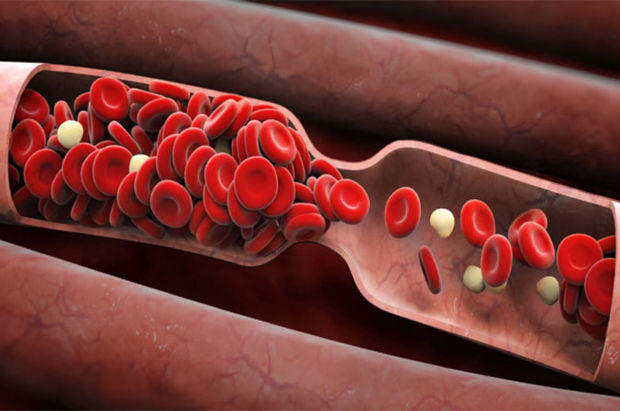 Bu xəstəliklər trombların yaranmasına səbəb olur - SİYAHI
