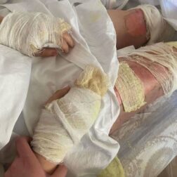 Partlayışda ağır yaralanan Ayselin xəstəxanadan FOTOSU YAYILDI