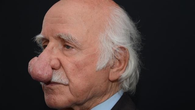 Türkiyədə yaşlı kişi qəribə xəstəliyə yoluxdu – Burnu böyüdü Türkiyədə yaşlı kişi qəribə xəstəliyə yoluxdu – Burnu böyüdü