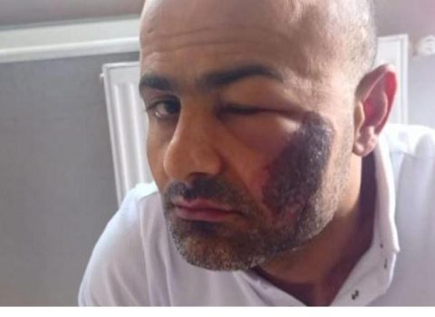 Lazer epilyasiyası etdirən kişinin başına iş gəldi