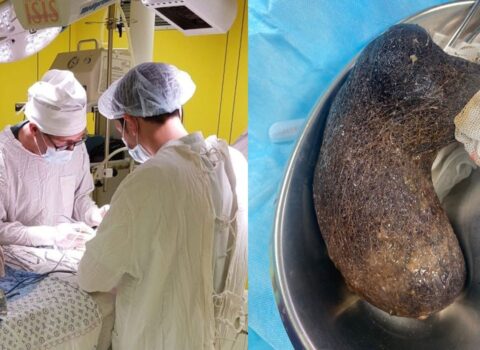 Həkimlər 10 yaşlı uşağın mədəsindən bir kiloqram saç və yun ÇIXARDI