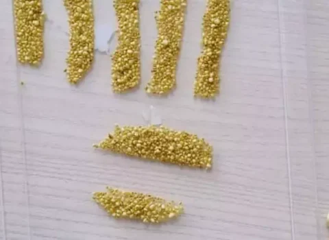 Xəstənin öd kisəsindən 1735 daş ÇIXARILDI – FOTO