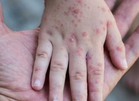Qızılcadan ölən 3 yaşlı Rüfətin atası: Oğlum bağçadan başqa heç yerə getmirdi – FOTO