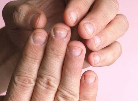 Dırnaqların rənginin dəyişməsi xəstəliklərin əlamətidir