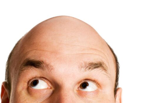 Keçəllikdən xilas edən YENİ ÜSUL