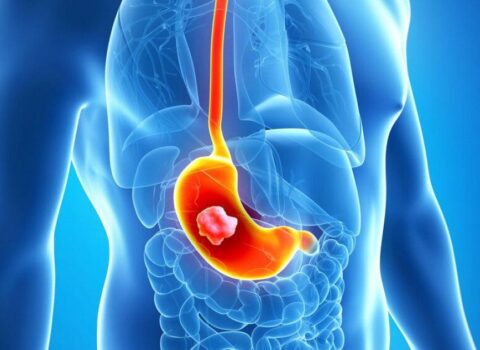 Həkimlərin “qara siyahı”sına düşən qidalar: xərçəngə səbəb olurlar