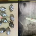 Bakıda bir nəfər 9 qaşıq uddu – ŞOK HADİSƏ – FOTOLAR