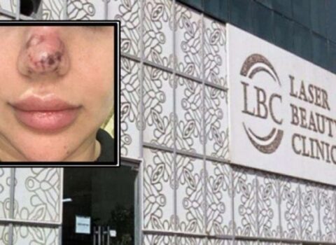 “Əməliyyatdan 4 gün sonra burnum qaraldı, 5 ay işə çıxa bilmədim” – Daha bir “estetika” dəhşəti – FOTO