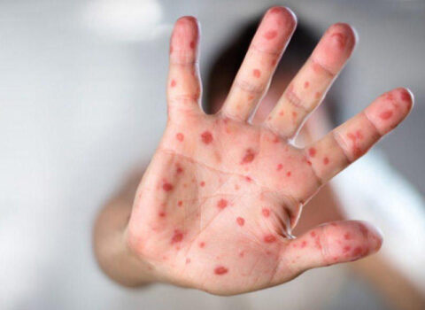 Azərbaycanda qızılca və suçiçəyi ilə bağlı epidemioloji vəziyyət necədir?