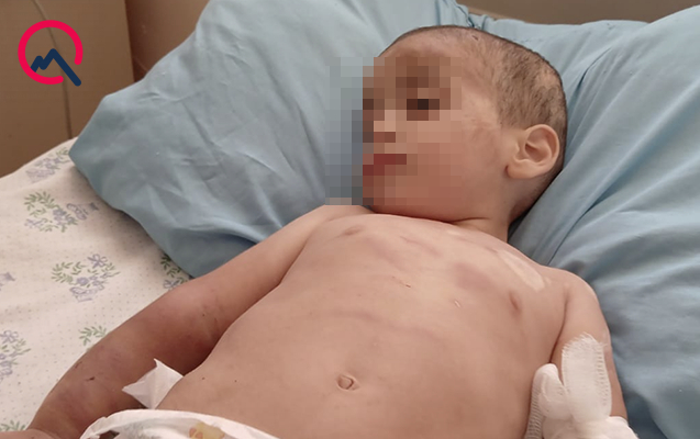 Valideynləri tərəfindən döyülən azyaşlının vəziyyəti ağırdır – TƏBİB