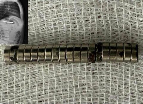 3 yaşlı uşağın boğazından 19 maqnit çıxarıldı – FOTO