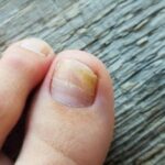 Pambıq və ya fırça ilə dırnağa çəkin – göbələyin kökünü kəsir