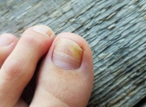 Pambıq və ya fırça ilə dırnağa çəkin – göbələyin kökünü kəsir