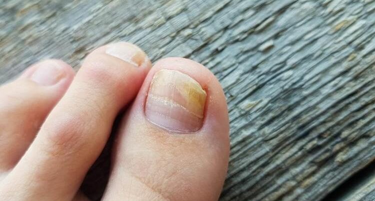 Pambıq və ya fırça ilə dırnağa çəkin – göbələyin kökünü kəsir Pambıq və ya fırça ilə dırnağa çəkin – göbələyin kökünü kəsir