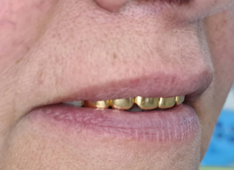 Ögey anasını yerə yıxaraq ağzında olan qızıl protezi aparan şəxsə cəza verildi