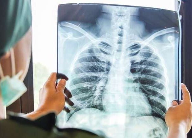 Ağciyər xərçənginin əsas səbəbi açıqlandı – Hər kəs risk altındadır