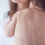 Yaz aylarında suçiçəyi xəstəliyi artır – Həkimdən XƏBƏRDARLIQ