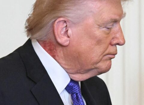 Trampın boynuna nə olub? – ŞOK fotolar yayımlandı