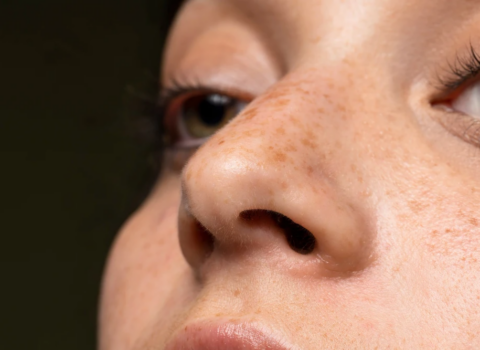 Üzdəki piqment ləkələrinin bilinməyən SƏBƏBİ