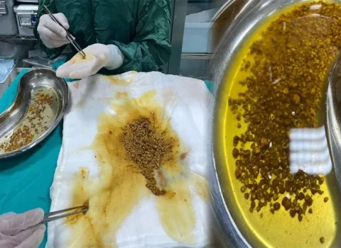 Tibb dünyasını təəccübləndirənəməliyyat – Öd kisəsindən 2067 daş çıxarıldı