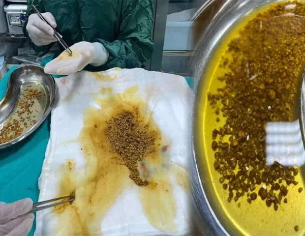 Tibb dünyasını təəccübləndirənəməliyyat – Öd kisəsindən 2067 daş çıxarıldı