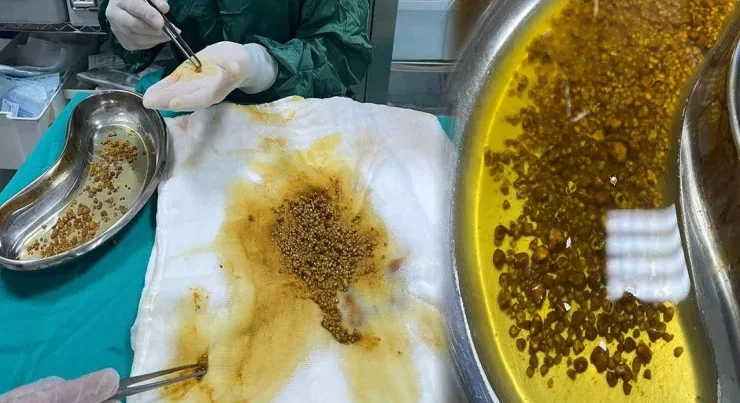Tibb dünyasını təəccübləndirənəməliyyat – Öd kisəsindən 2067 daş çıxarıldı