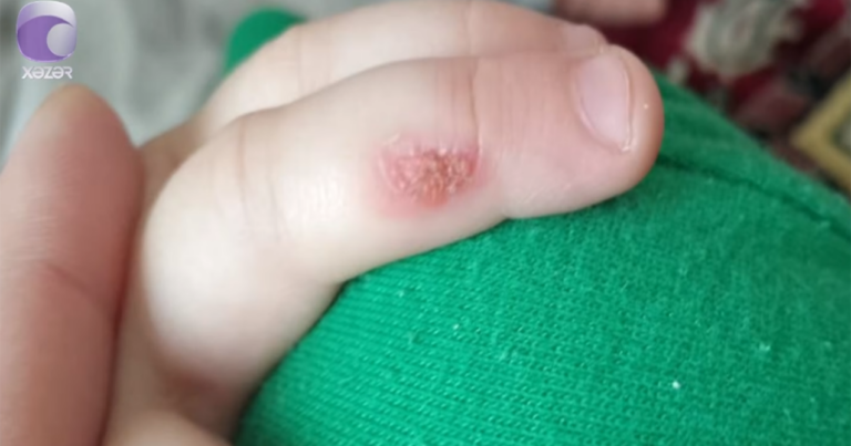 Bağça müəllimi bıçağı qızdırıb, uşağın əlinə basıb? – VİDEO