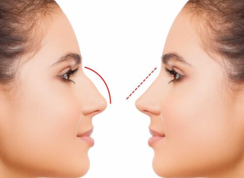 Azərbaycanda bu şəxslərə burun əməliyyatı pulsuz OLDU