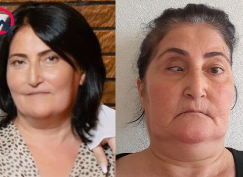 Bu klinika təzminat ödəyəcək – Burun düzəldəndə gözü zədələdi – FOTO