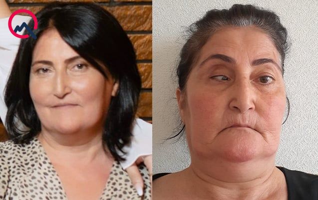 Bu klinika təzminat ödəyəcək – Burun düzəldəndə gözü zədələdi – FOTO