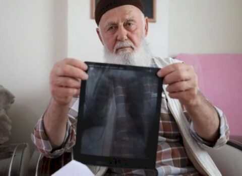Siqaretə görə 3 barmağını itirdi – FOTOLAR